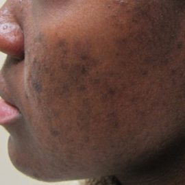 Dark Spots Or Hyperpigmentation Of The Skin