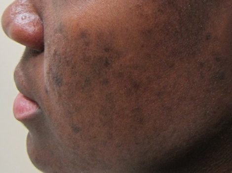 Dark Spots Or Hyperpigmentation Of The Skin